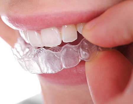 Dental Aligners in Vijayawada