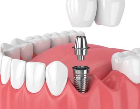 Dental Crowns and Bridges in Vijayawada