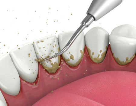 Gum Surgery in Vijayawada