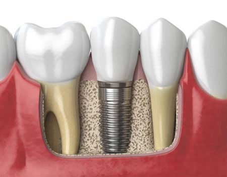 dental implants in Vijayawada