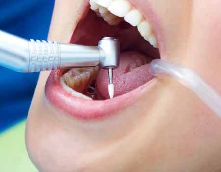 root canal treatment in Vijayawada