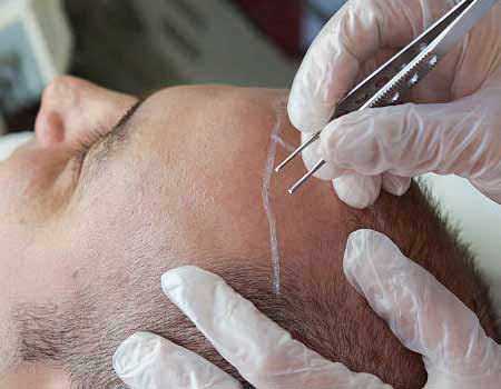 Hair Transplantation in vijayawada