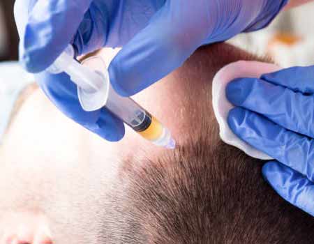 PRP treatment in vijayawada