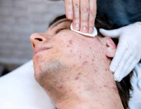 Acne Treatment in Vijayawada